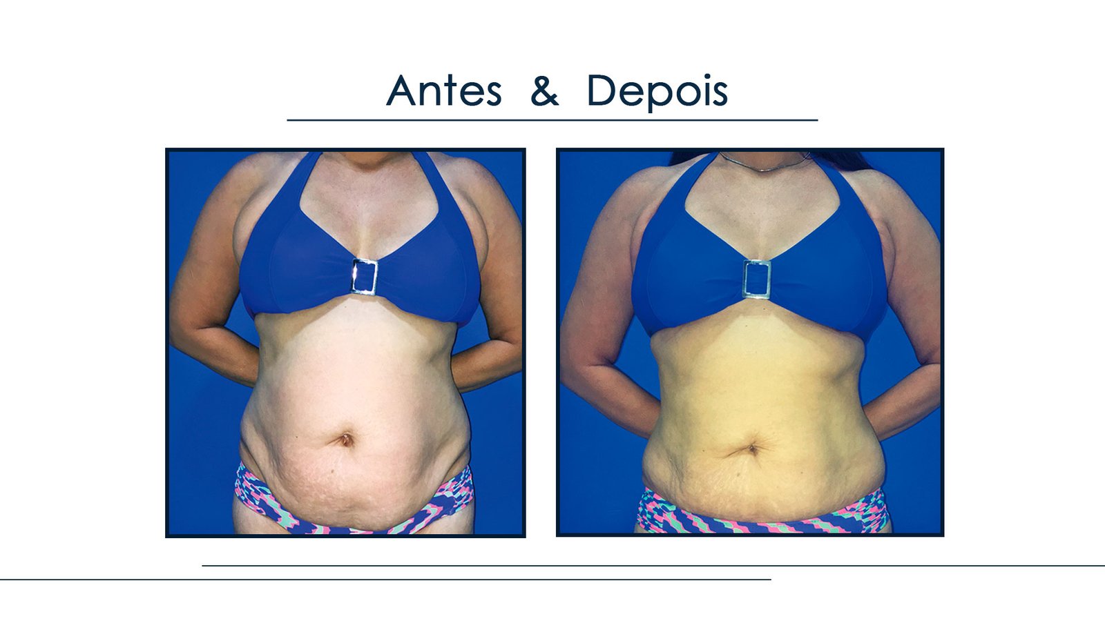 Antes e Depois Gordura