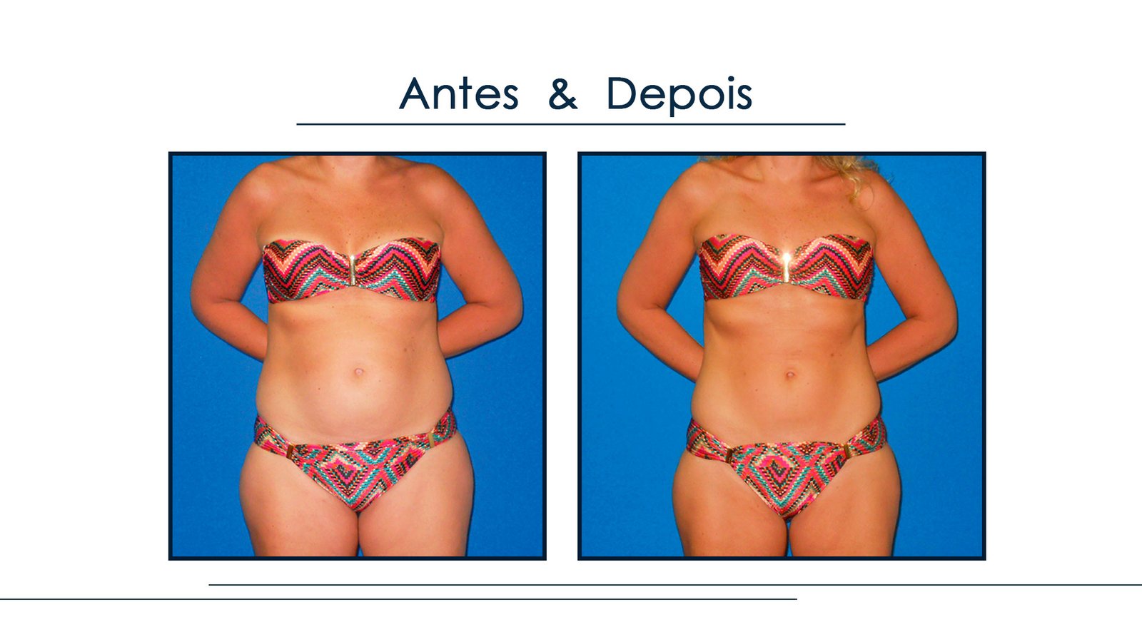 Antes e Depois Gordura