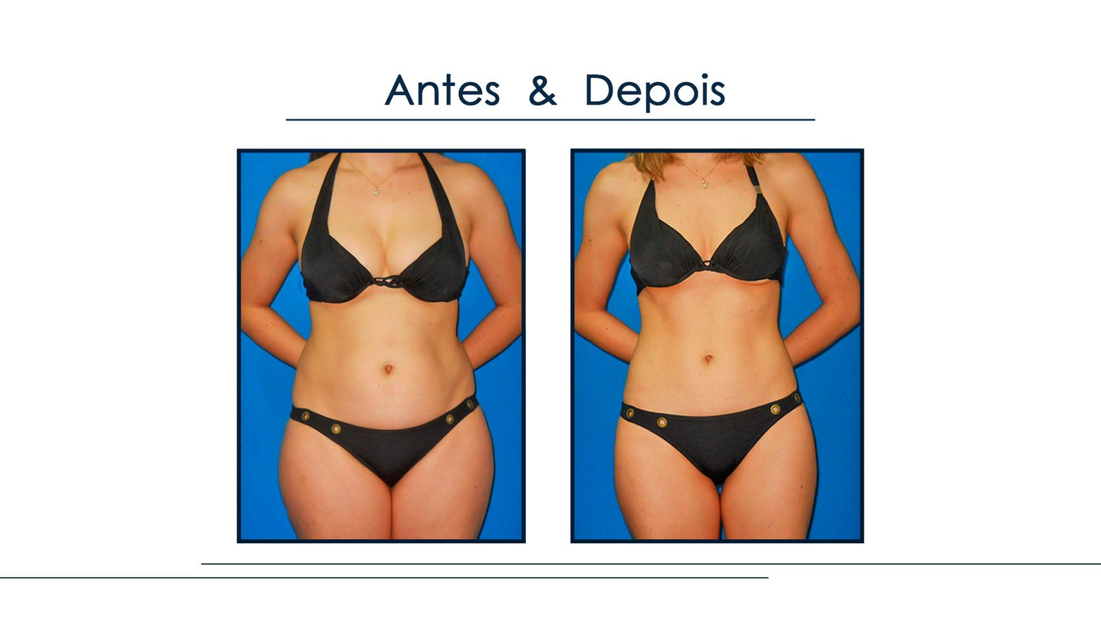 Antes e Depois Gordura