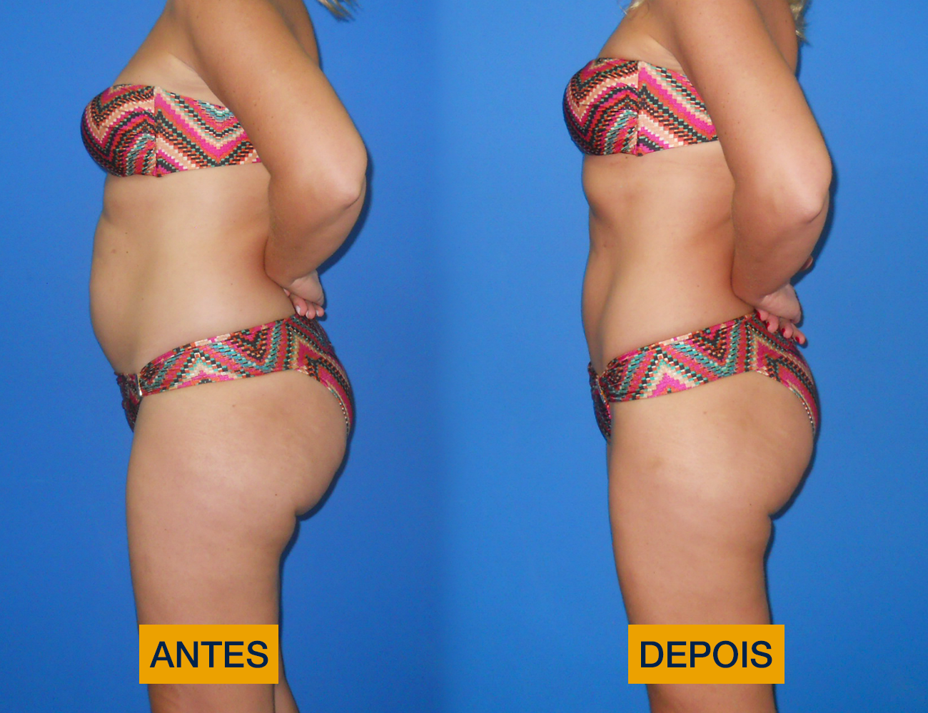 Antes e depois gordura localilzada