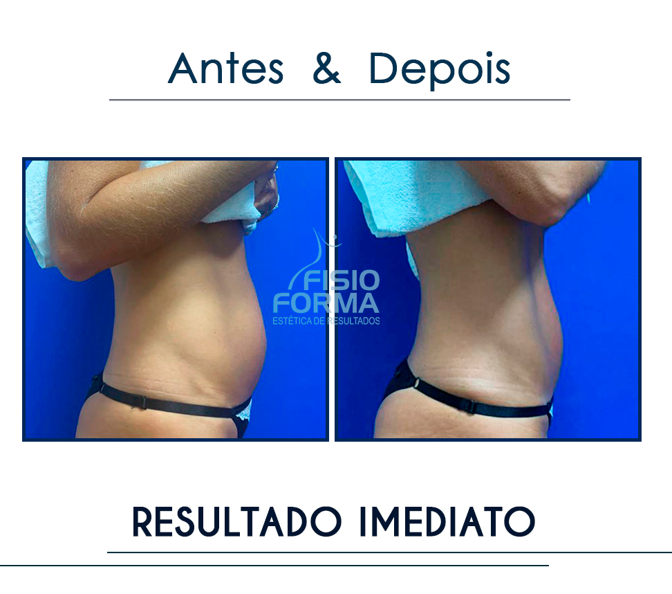 resultado imemdiato gordura localilzada